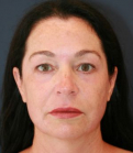 Feel Beautiful - Three Months After - After Photo